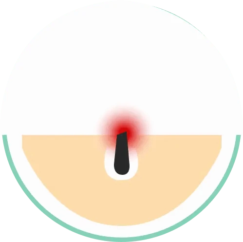 What Is Pseudofolliculitis Barbae and How Do You Treat It?