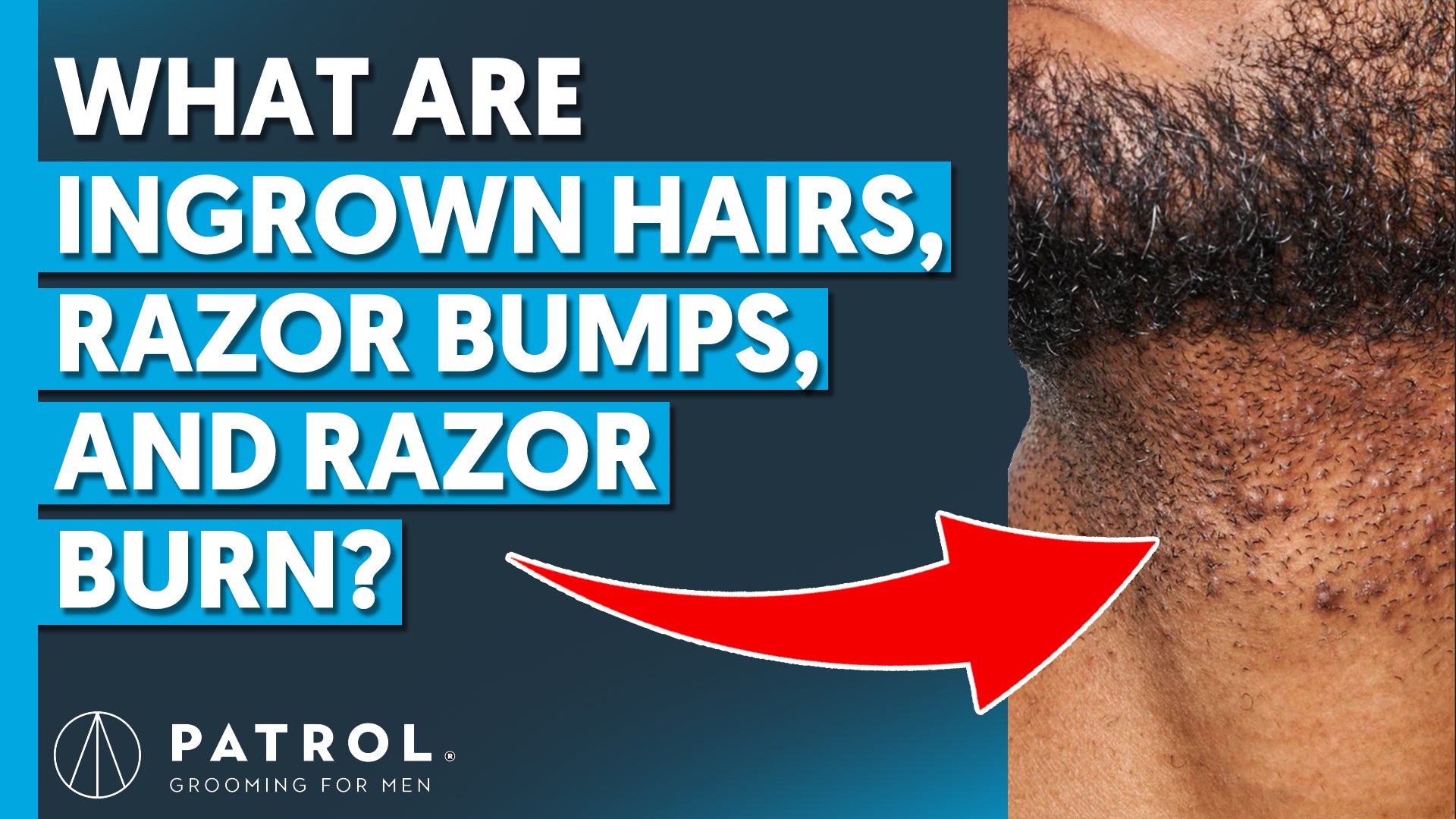 Ingrown Hairs, Razor Bumps, Razor Burn & Irritation