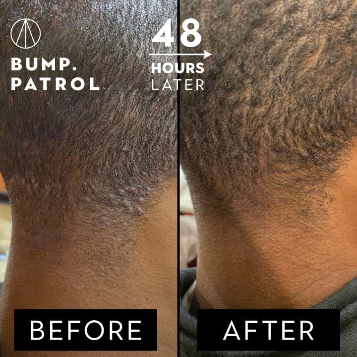 razor bump treatment