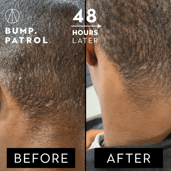 Aftershave for Bumps: Eliminating Ingrown Hair & Irritation